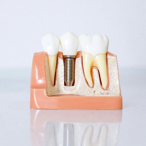 Implant dentaire — maquette haute définition