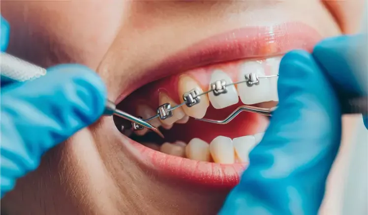 Orthodontie avec bagues et gouttières invisibles